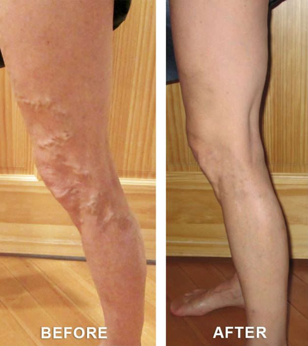 Before & After Vein Treatment Gallery | Vincent Vein Center