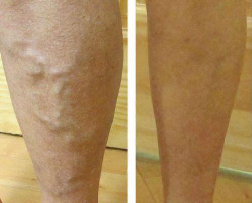 before and after images of vein treatment by Dr. Vincent