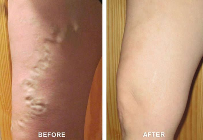 before and after vein treatment in grand junction co