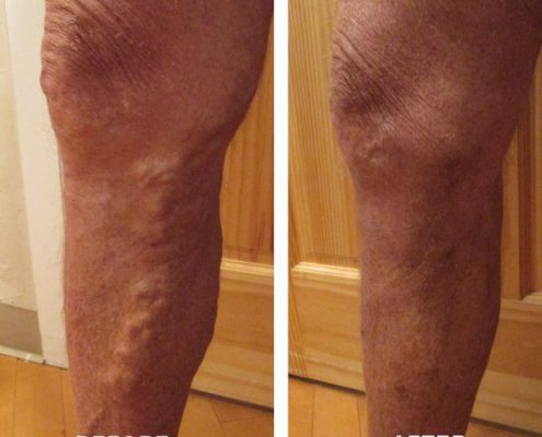 vein disorders before and after
