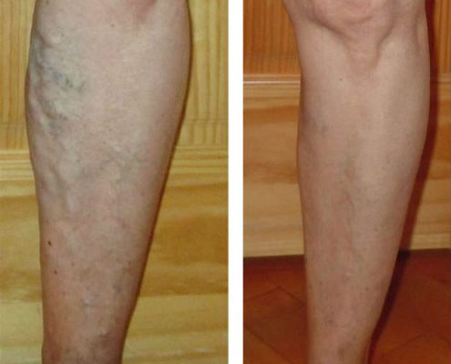 before and after spider vein treatments