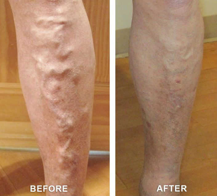 Before and after varicose vein procedures