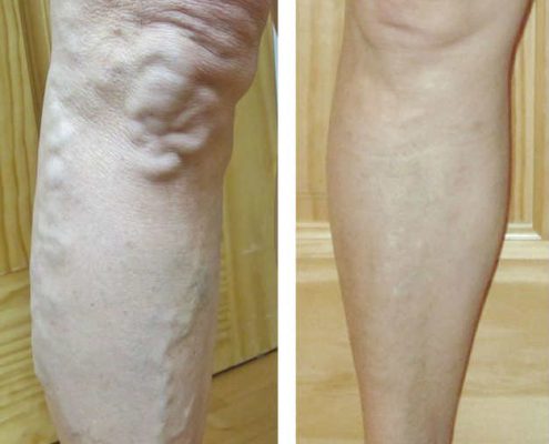 Varicose Veins - Assessment & Treatment