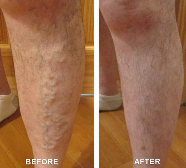 Before and After Varicose Veins Treatment 
