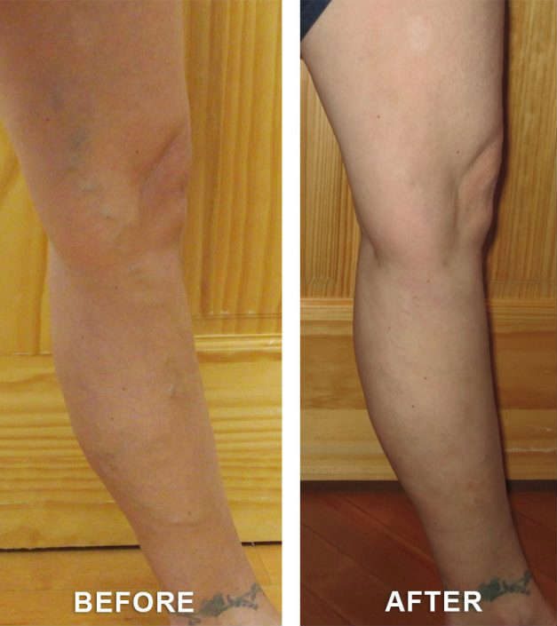before and after vein treatment in grand junction