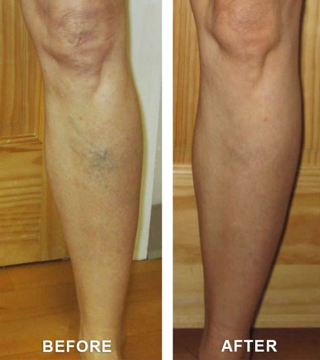before and after vein treatment in grand junction