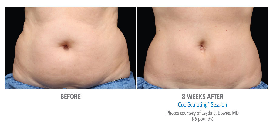 CoolSculpting ® - Freeze Away Fat!