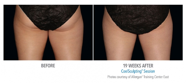 female inner thigh before and after coolsculpting session