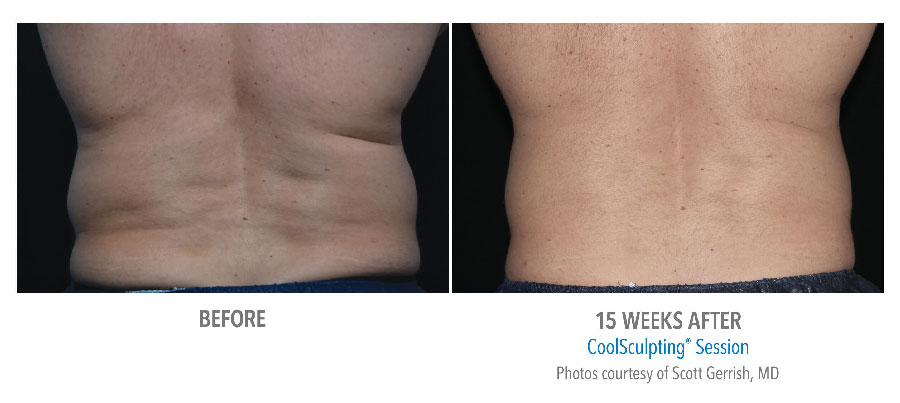 CoolSculpting ® - Freeze Away Fat!