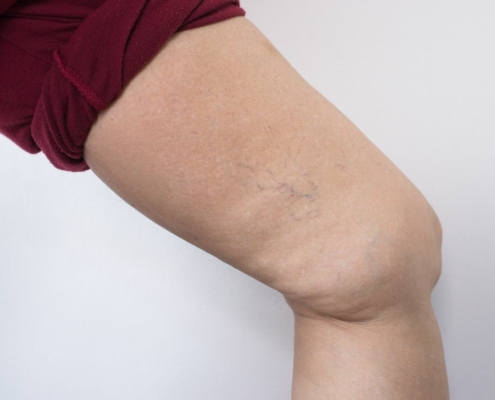 How to Instantly Relieve Varicose Vein Pain 