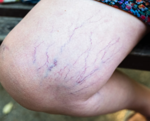 Spider Vein services for a woman's leg 