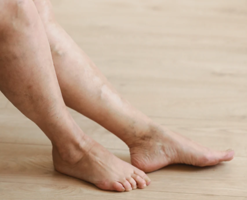 Varicose Veins on a Woman's legs 
