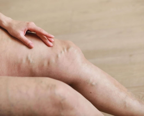 Varicose Veins on Woman's Leg