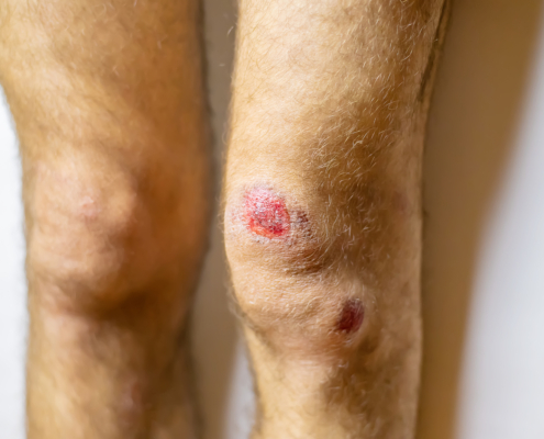 Close-up of a patient’s knees showing a venous stasis ulcer.