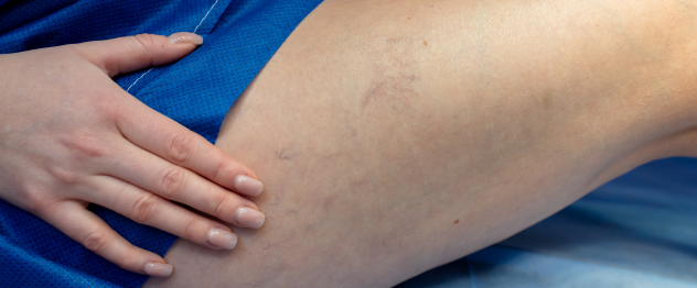 Close up image of veins on women's leg