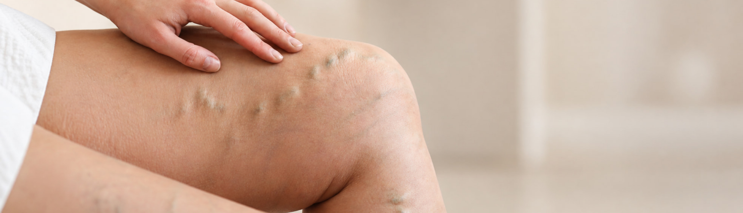 Vincent Vein Clinic Grand Junction Knee with Vein Problems